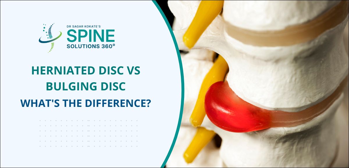 Herniated Disc vs Bulging Disc: What's the Difference?